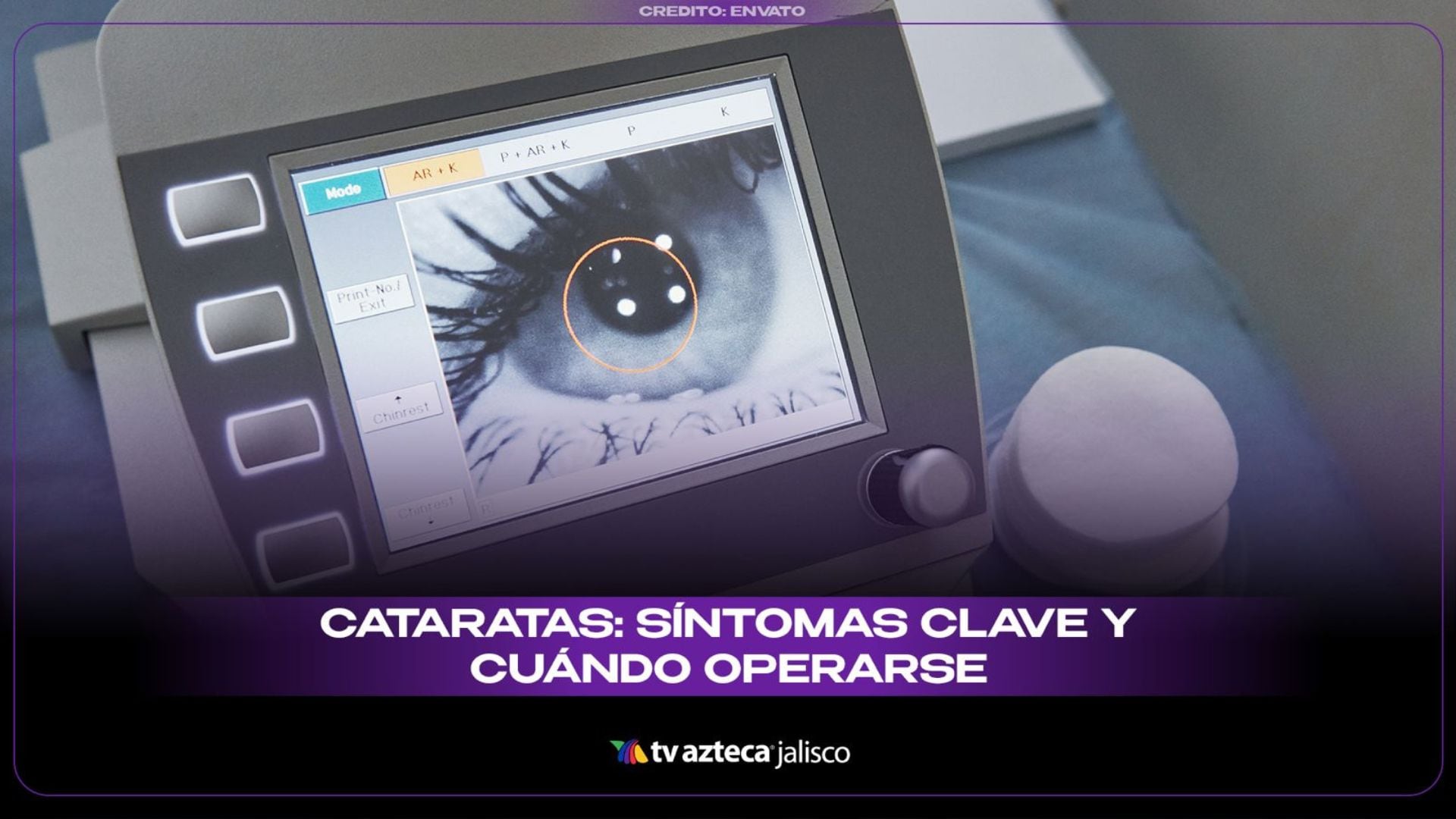 ¿Tienes la visión borrosa? Estos síntomas podrían revelar la presencia de CATARATAS