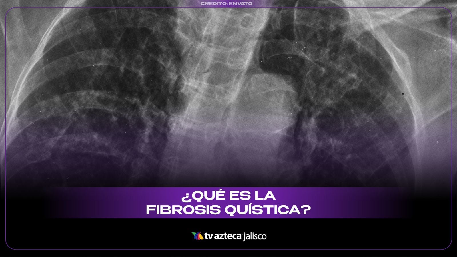 Silenciosa y progresiva: Las 5 señales de la fibrosis quística que no debes ignorar