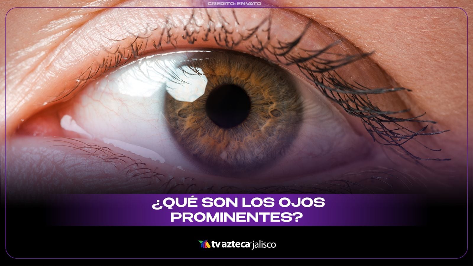 ¿Qué son los ojos prominentes? Caso clínico: 'Muerte en vida'